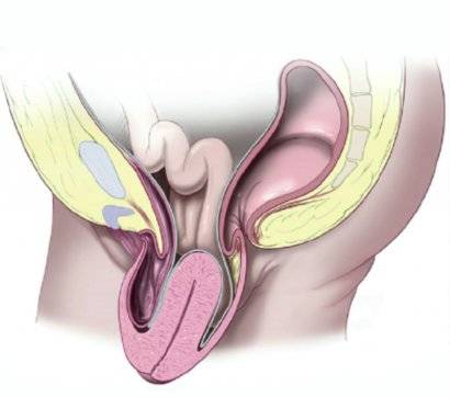 uterotsele
